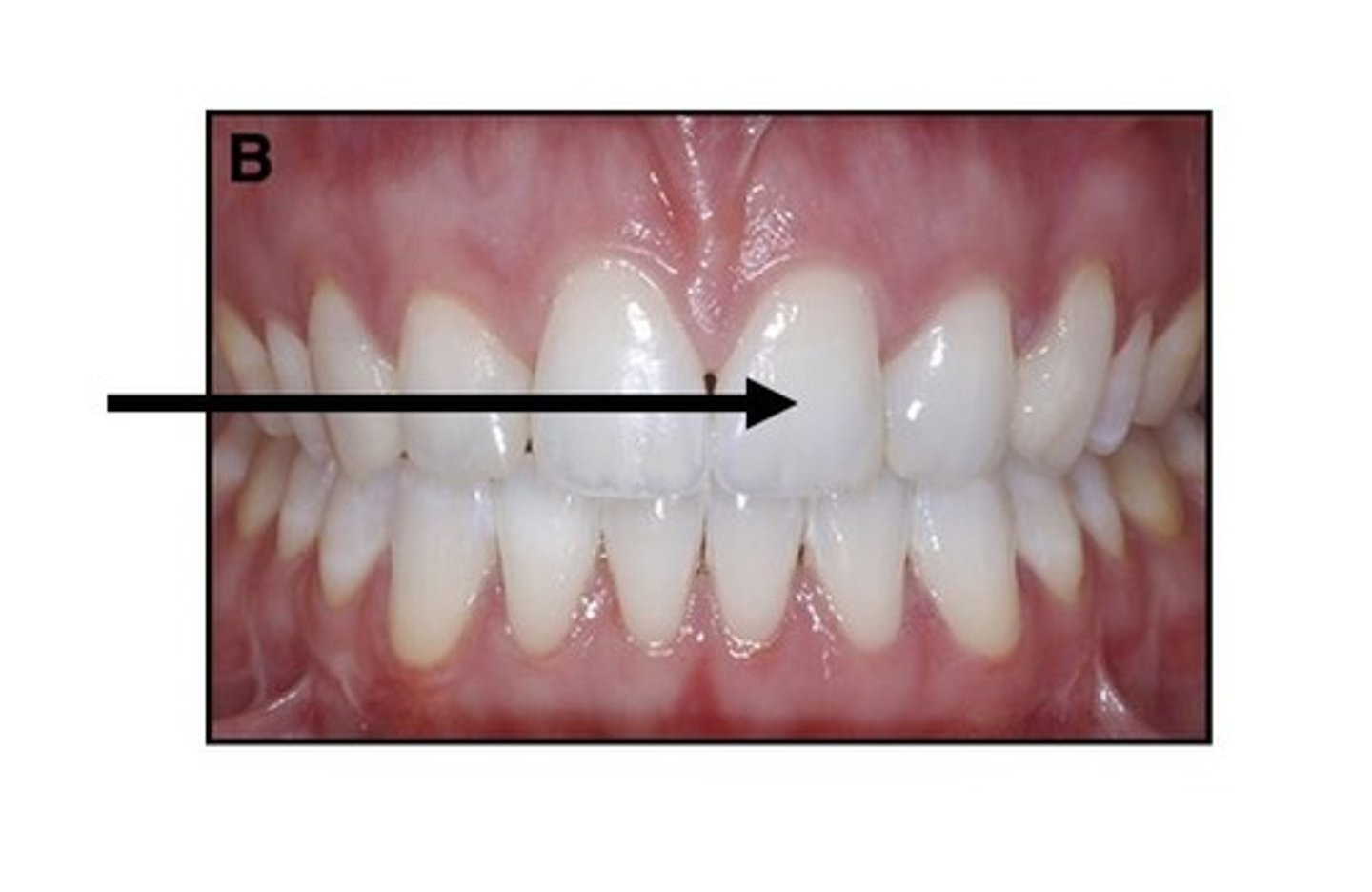 <p>Using the Universal Numbering System, what tooth number is this?</p>