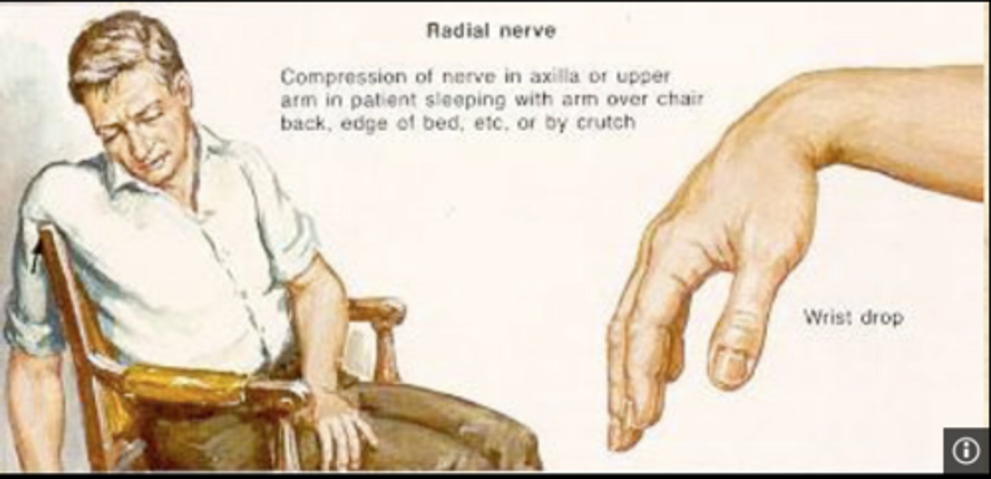 <p><strong>"saturday night palsy"</strong> </p><p>-hyperabduction </p><p>-fall asleep w arm up </p>