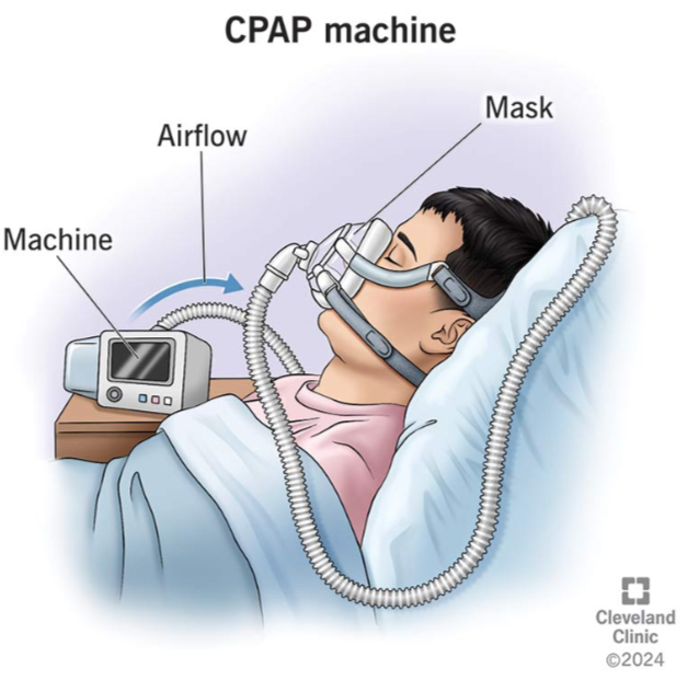 <p>CPAP</p>