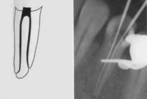 <p><span>(2)</span></p><p><span>two separate canals leaving the pulp chamber and exiting from the root in separate apical foramina</span></p>