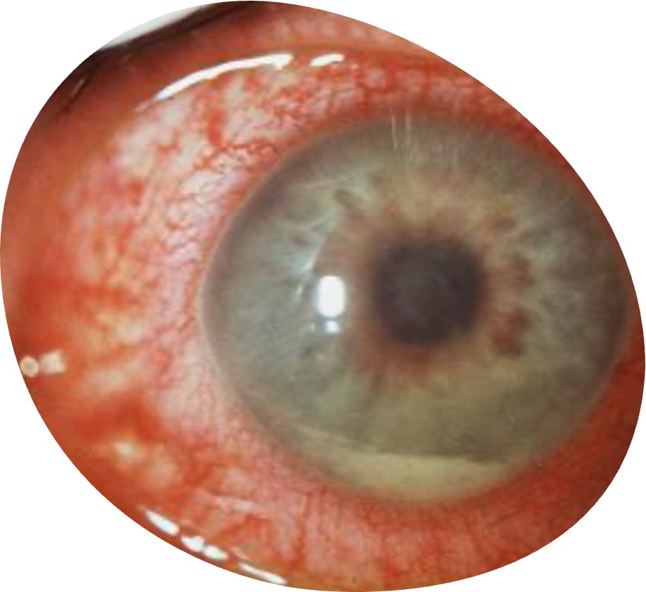 <p>inflammation of uvea</p>