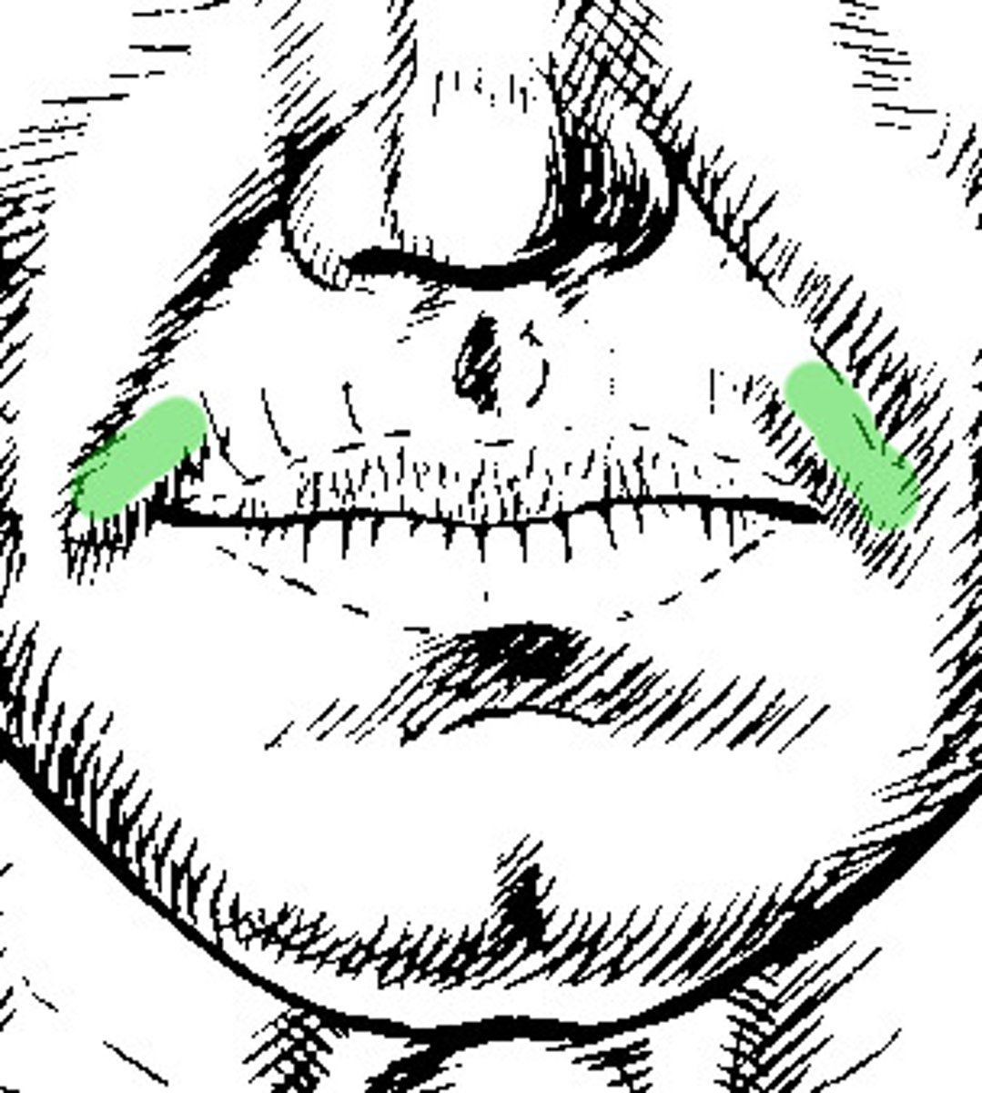 <p>elevation on the corner of the mouth</p><p>caused by the insertion points of the muscles of the mouth</p>