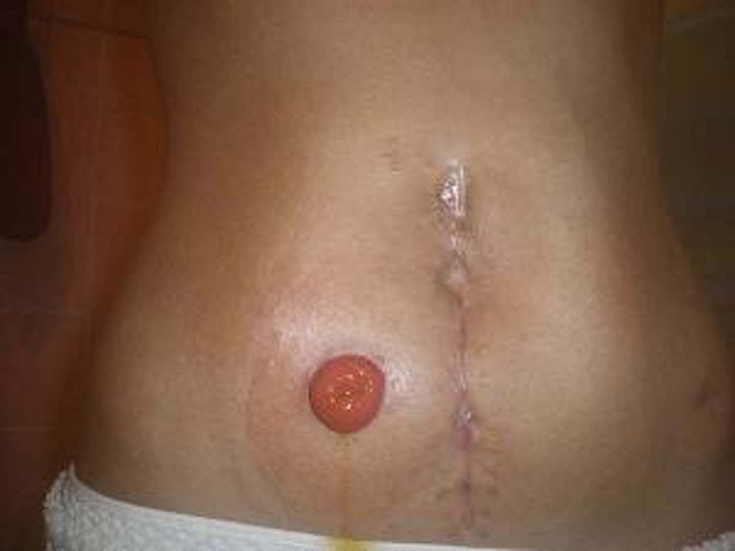 <p>opening of the intestine from the skin</p>