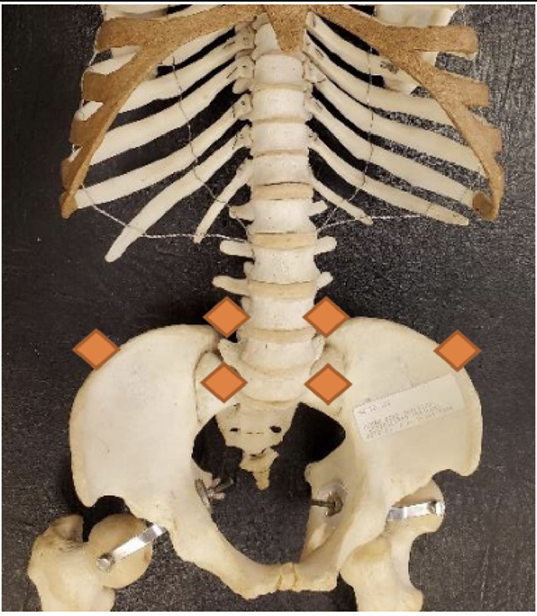 <p>1/4 distance between umbilicus and pubic symphysis; just lateral to midline bilaterally</p>