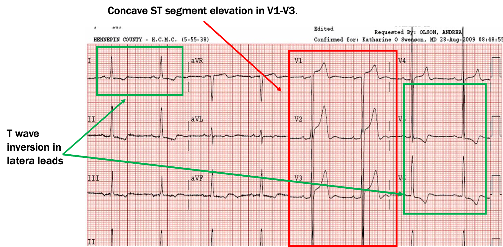 <p>LVH (concave upward contour ST seg elevation in V1-V3, T wave inversion on lateral leads)</p>