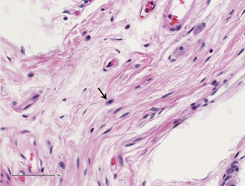 <p>Classify the predominant CT in the field of view.  ID the cell at the arrow.</p>