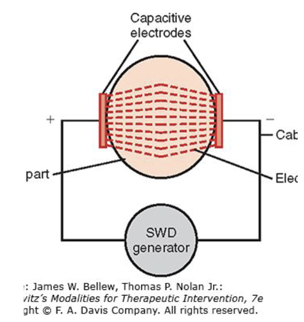 <ul><li><p><span>Uses an applicator system that requires that the patient’s tissues become part of a capacitor</span></p></li><li><p><span>Uses a rapidly alternating high-frequency current (AC) that creates a voltage differential between two electrodes</span></p></li><li><p><span>Electrodes are placed either one on each side</span></p><ul><li><p><span>Or both on the same side of the part of the body</span></p></li></ul></li><li><p><span>Each of the two electrodes has a different polarity</span></p></li><li><p><span>The patient is placed between two electrodes or plates and becomes part of the circuit</span></p></li></ul><p></p>