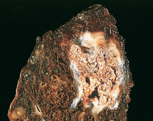 <p>pulmonary infection (usually tuberculosis ); dead cells disintegrate but leave cellular debris (clumped cheese)</p>