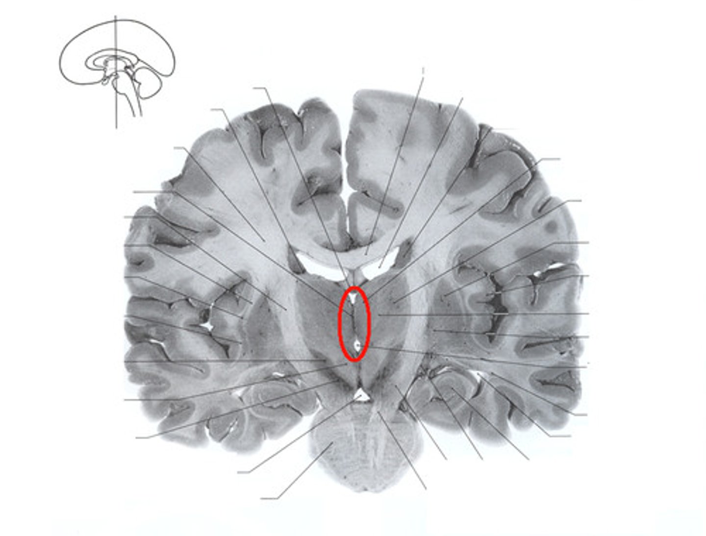 <p>One of four connected fluid-filled cavities comprising the ventricular system within the human brain. The central cavity of the brain, lying between the thalamus and hypothalamus of the two cerebral hemispheres.</p>