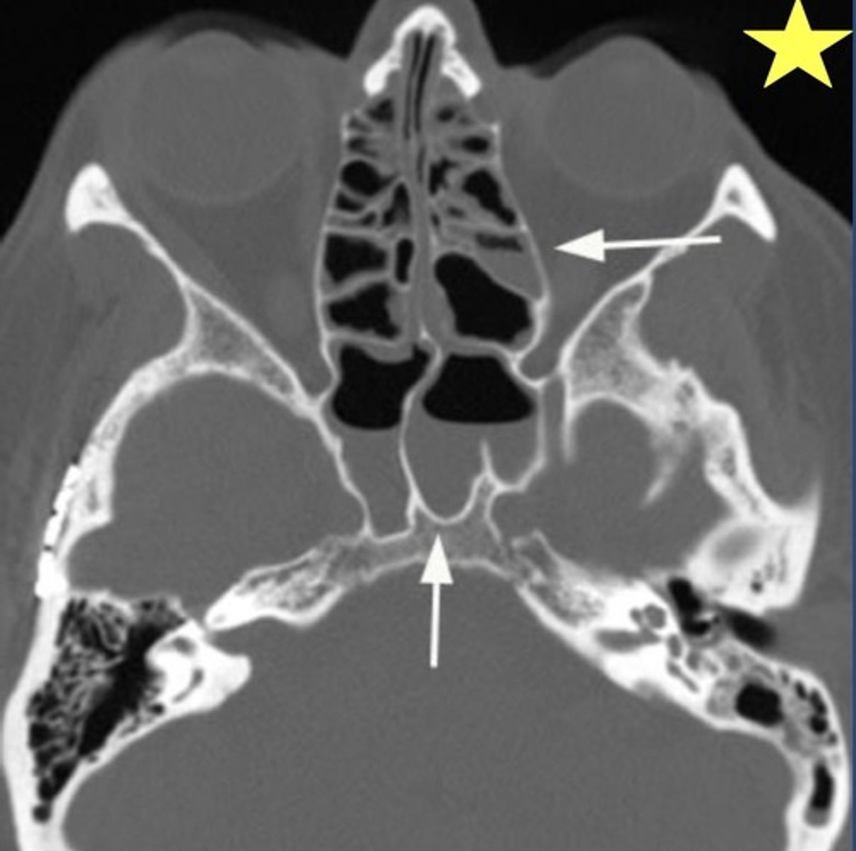 <p>Identify the radiographic abnormality. Also identify the location.</p>
