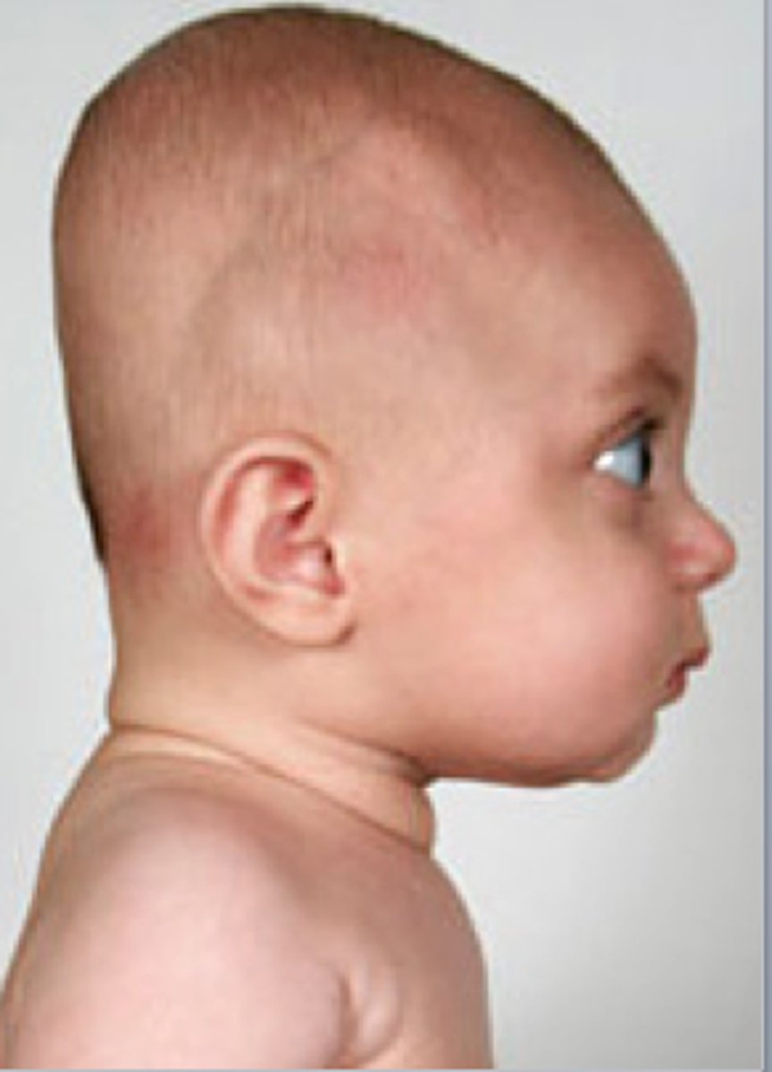 <p>flattening of the head</p>