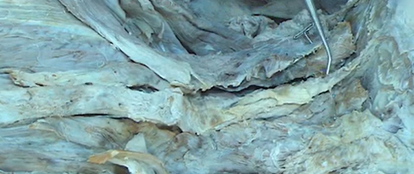 <p>A thickened supraspinous ligament in the cervical region of the spinal column.</p>