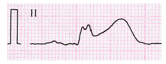 <p><span><span>Which deviation is shown in the EKG strip?</span></span></p>