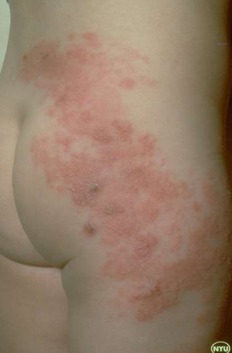 <p>Welke infectie is dit?</p>