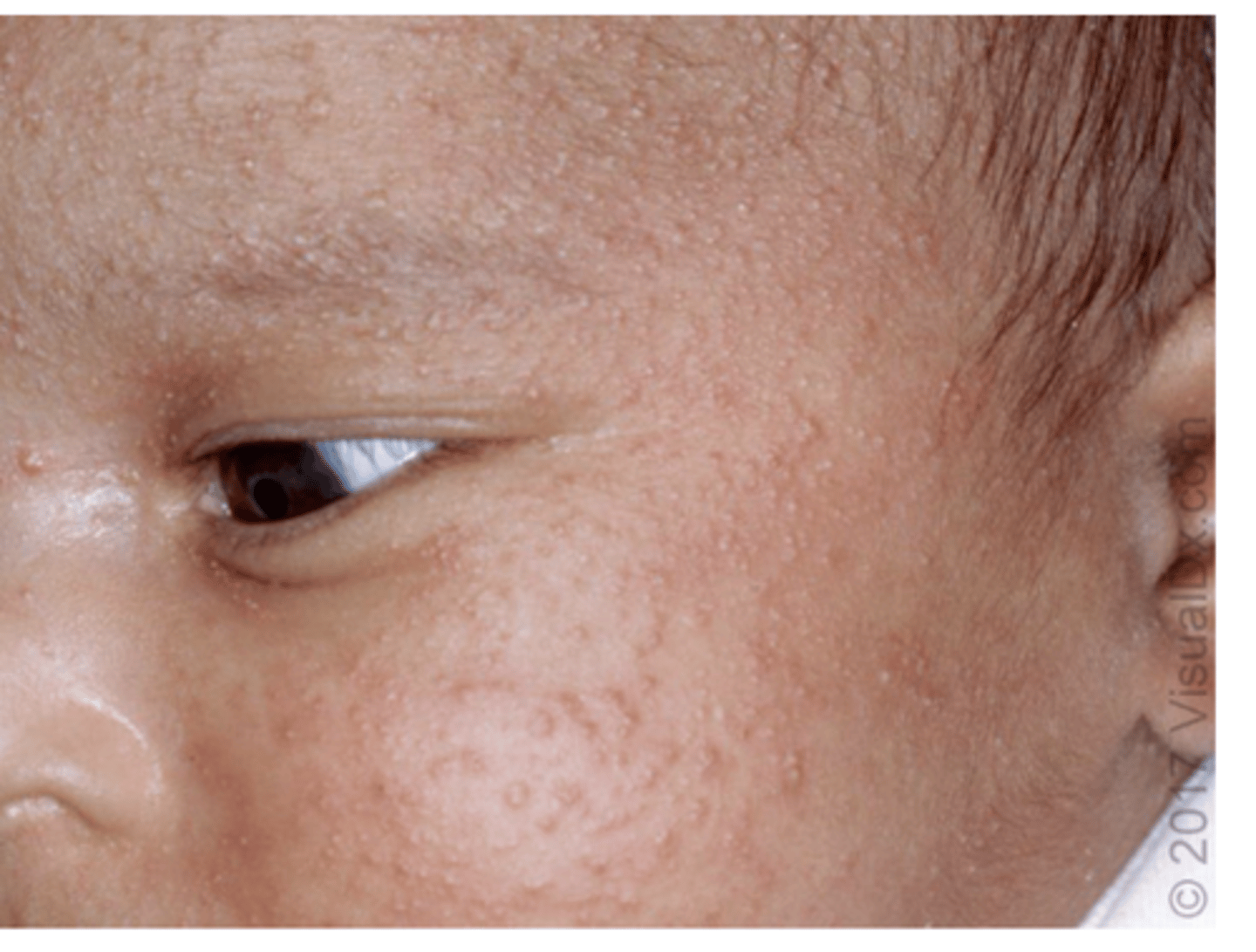 <p>neonatal acne limited to the face and scalp</p>