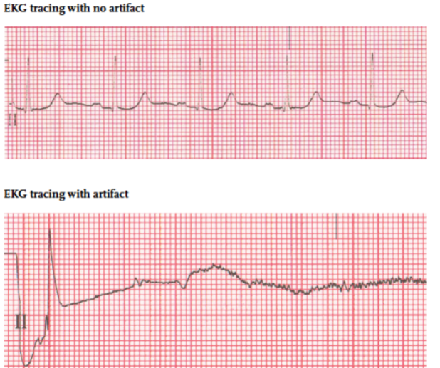 <ul><li><p>interference or distortion that appears on an EKG tracing - may be caused by</p><ul><li><p>Environmental factors </p></li><li><p>Defective equipment </p></li><li><p>Patient conditions</p></li></ul></li></ul><p></p>