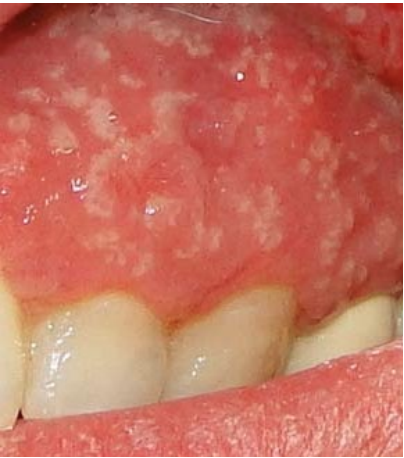 <p>What lesion is this?</p>
