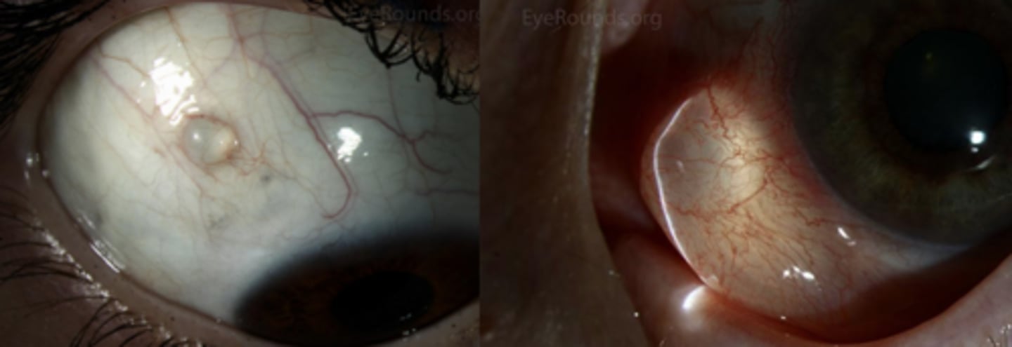 <p>displaced conj epithelial cells form a cystic cavity = thin-walled cyst is filled with seroud fluid</p>