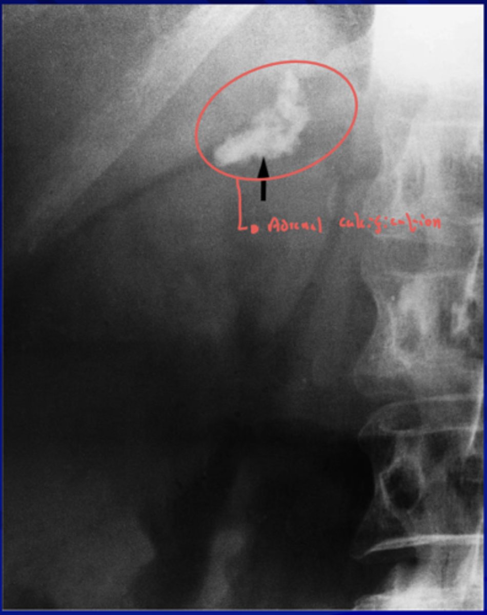 <p>- Adrenal hemorrhage</p><p>- Tuberculosis</p>