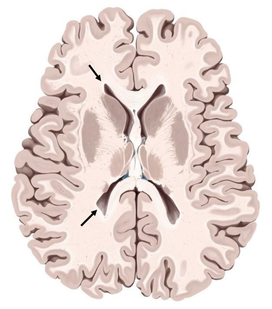 <p>Which ventricles are these (horizontal section)?</p>
