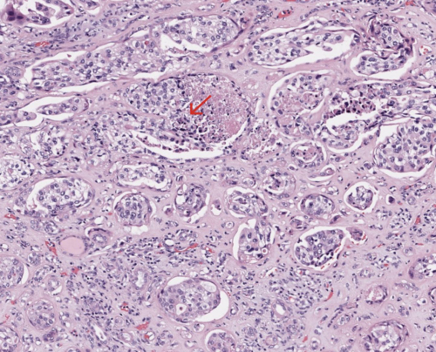 <p>Urothelial tract</p>