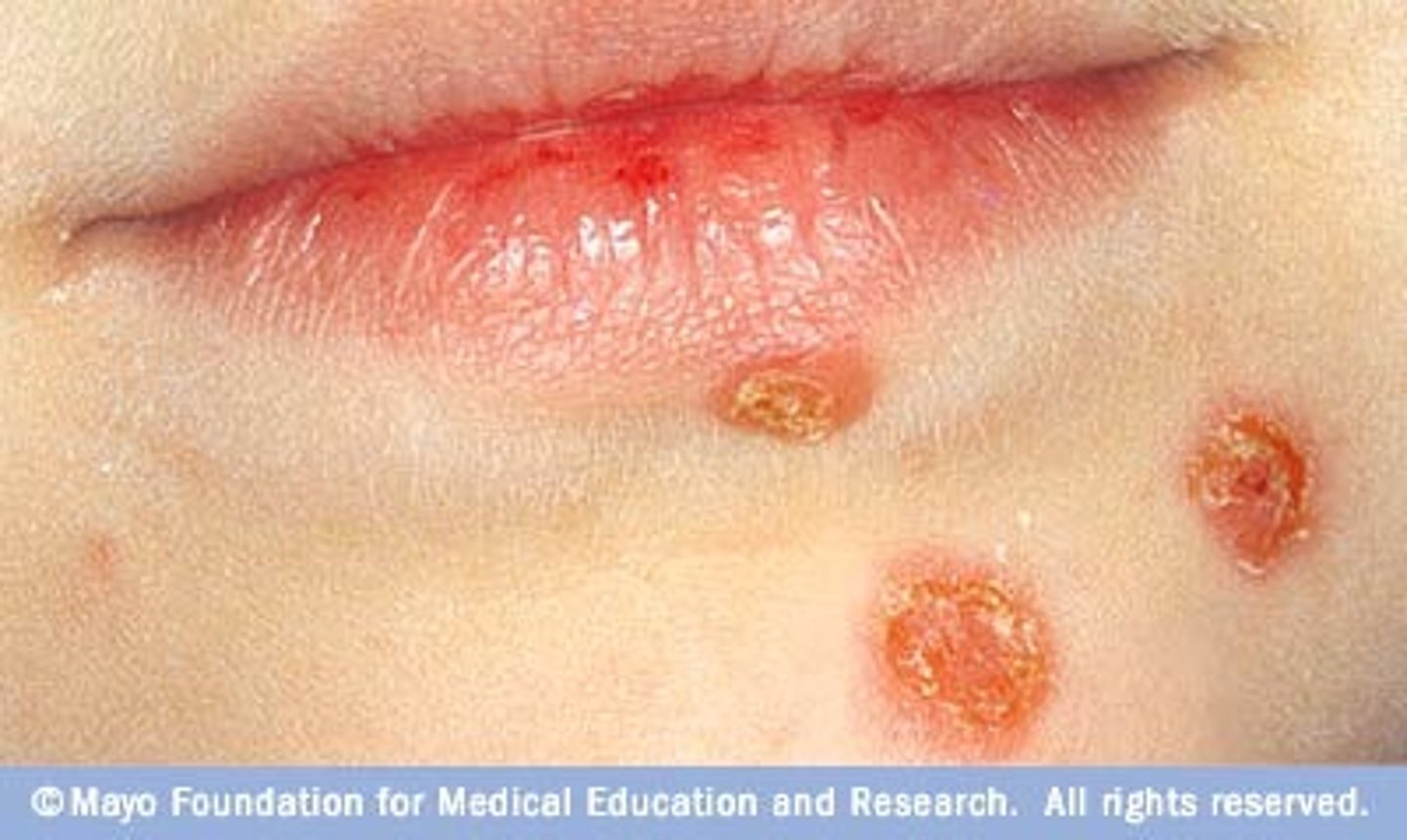 <p><b>secondary skin lesion</b><br><br>The dried residue of skin exudates such as serum, pus, or blood that can be red-brown, orange or yellow</p>