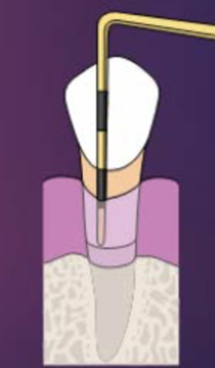 <p>- Calculated by ADDING probing depth to gingival margin level</p><p>- Probe Depth= 4mm</p><p>- GM Level= + 2mm6 mm</p><p>- Clinical Attachment Loss = 6mm</p>