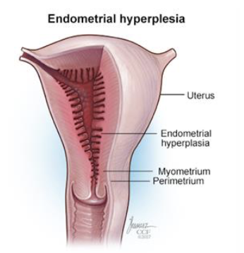 <ol><li><p><strong>Perimetrium </strong></p><ul><li><p><span style="color: purple;"><strong><mark data-color="purple" style="background-color: purple; color: inherit;">Outermost serous layer</mark></strong></span> (visceral peritoneum) </p></li></ul></li><li><p><strong>Myometrium </strong></p><ul><li><p><span style="color: purple;"><strong><mark data-color="purple" style="background-color: purple; color: inherit;">Bulky middle layer</mark> consisting interlacing layers of smooth muscle</strong></span></p></li><li><p>Contracts rhythmically during childbirth </p></li></ul></li><li><p><strong>Endometrium </strong></p><ul><li><p><span style="color: purple;"><strong><mark data-color="purple" style="background-color: purple; color: inherit;">Mucosal lining </mark></strong></span></p></li><li><p><span style="color: purple;"><em>Simple columnar epithelium </em></span></p></li><li><p>Fertilized egg burrows into endometrium and resides there during development </p></li></ul></li></ol><p></p>