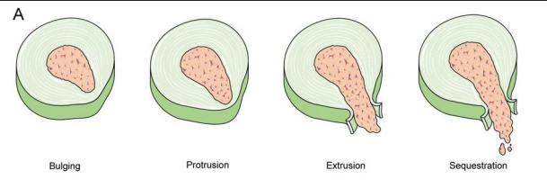 <p>Terminology describing disc pathology by extent and direction of disc material displacement.</p>