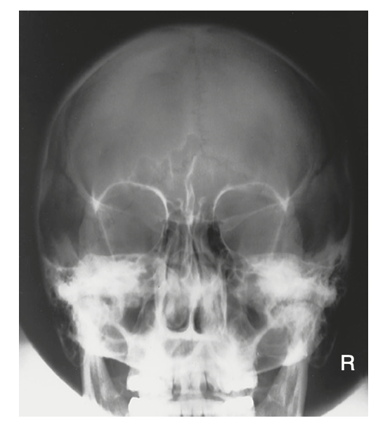 <p>What is the <u>tube angle</u> used for <strong>PA axial projection (</strong><span style="color: blue"><strong>Caldwell</strong></span><strong>) </strong>method for <strong>skull</strong>?</p>