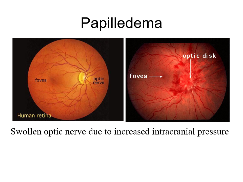 <p>Very painful, retina comes off the back of the eye</p>
