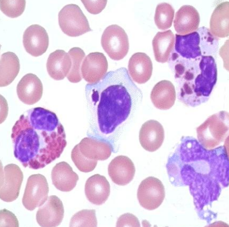 <p>What condition causes <strong>large lysosomal, peroxidase + granules</strong> in cells?</p>