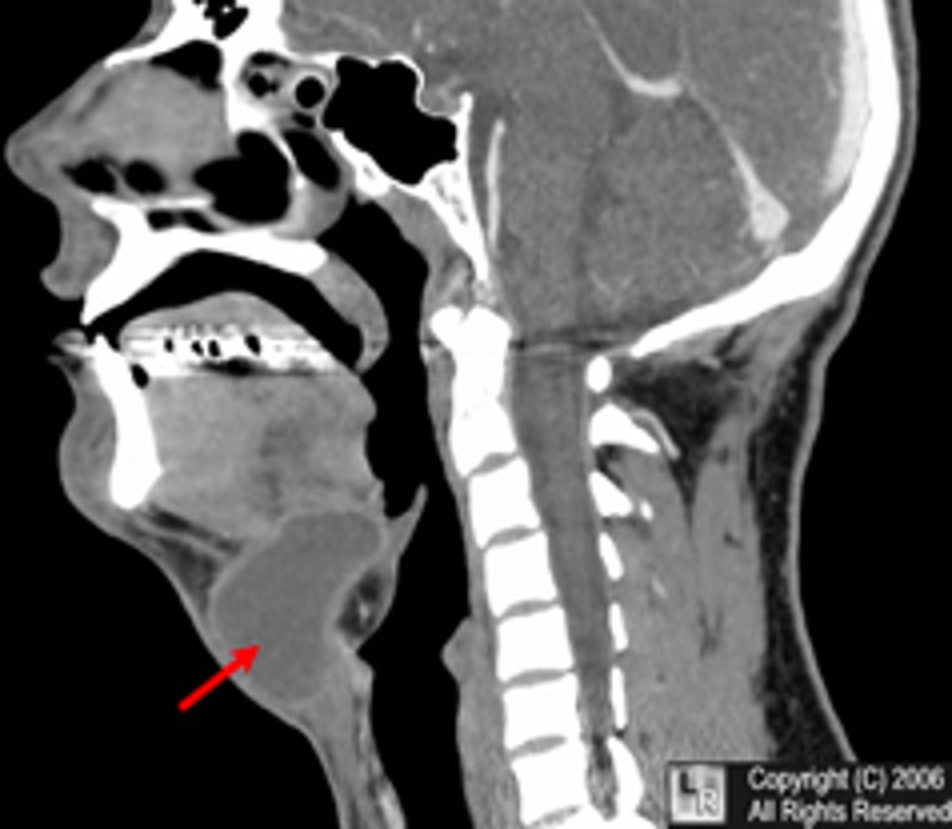 <p>presents as a painless swelling in the midline near hyoid bone that moves when swallowing. What is the diagnosis?</p>