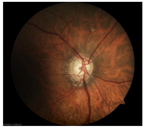 <p>Group of distinct optic neuropathies distinguished by a distinct characteristic pattern of progressive excavation of the nerve head without significant pallor</p><p>Affects<strong> RGC and their axons</strong></p><p><strong>Increased cup-to-disc ratio</strong></p>