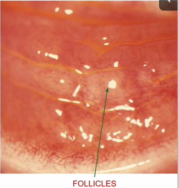 <ol><li><p><strong><mark data-color="yellow" style="background-color: yellow; color: inherit"><u>follicular reaction </u></mark></strong></p><ol><li><p>can also see in chlamydia and toxic conj</p></li></ol></li></ol><p></p>