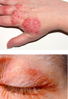 <p>atopic eczema</p><p>skin is itchy, dry and cracked</p>