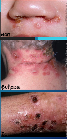 <p><strong>Impetigo: Background</strong></p><p>-Most frequently seen in children ages 2-5 years old </p><p>-Commonly caused by _____ ________ or GAS</p><p>-Non-Bullous (MC) </p><ul><li><p>____ papules → vesicles → _________ → enlarge then break down → forms thick yellow/honey colored ______</p></li><li><p>Most commonly affects the _____ and extremities </p></li></ul><p>-Bullous</p><ul><li><p>Seen mostly in ______ children </p></li><li><p>Vesicles enlarge → form _____ with clear, yellow fluid → ruptures → leaves a ________ crust </p></li><li><p>Usually affects the _____</p></li></ul><p>-Ecthyma </p><ul><li><p>Ulcerative form, where the lesion extends into the ______</p></li></ul><p></p>