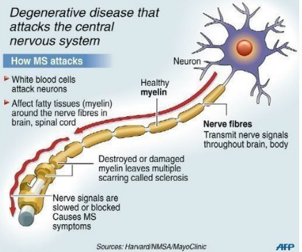 <ul><li><p>Destroyed or damaged myelin leads to scarring (sclerosis)</p></li><li><p>Autoimmune process</p></li><li><p>Activated T cells migrate to CNS, disrupting blood-brain barrier</p><ul><li><p>Likely the initial event in development of MS</p></li></ul></li><li><p>Subsequent antigen-antibody reaction leads to demyelination of axons</p></li></ul><p></p>