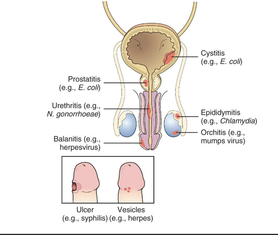 <ul><li><p>inflammation of the prostate gland</p></li><li><p>usually an acute illness with fever, back pain, dysuria and other urination problems</p></li><li><p>usually infection with GN uropathogens, <em>E. coli</em> is a frequent cause</p></li><li><p>location of the prostate males inflammation/infection of this gland a painful lesion</p></li></ul><p></p>