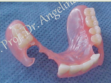 <ul><li><p>plastic toot-alveolar clasps </p></li><li><p>main indication: abutment teeth mobility </p></li></ul><p></p>