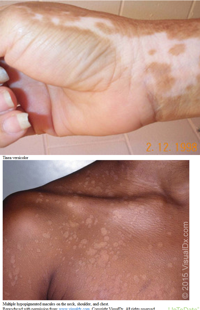 <p>acquired after partial or total loss of pigment that may occur after inflammation or infectious dermatoses; hypopigmented macules/patches</p>