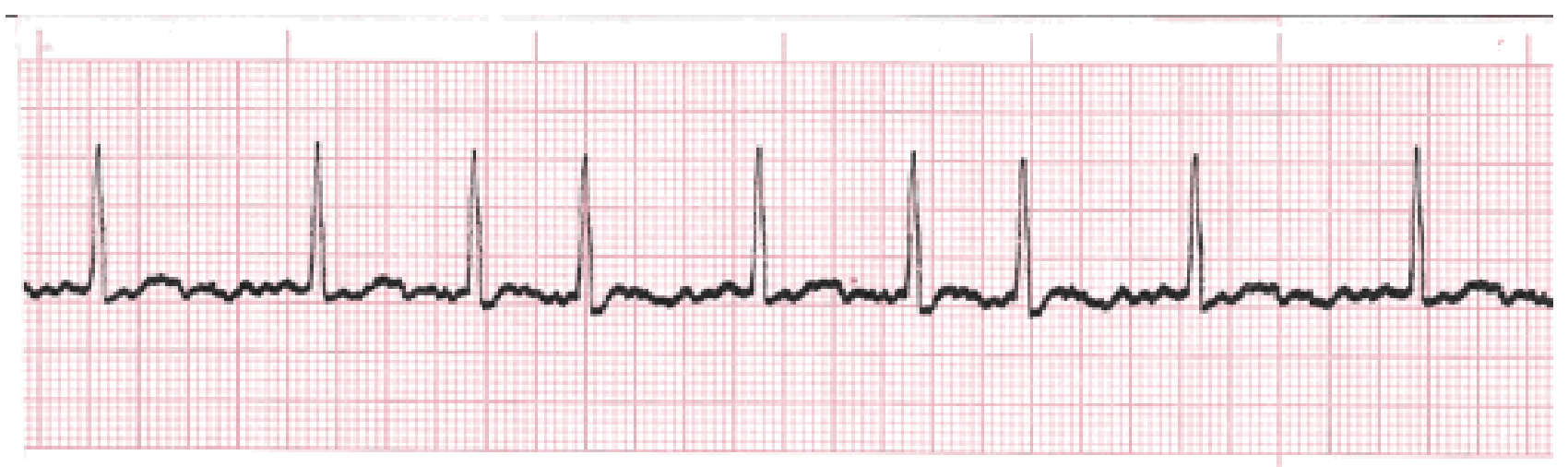 <p>What is the rhythm?</p>