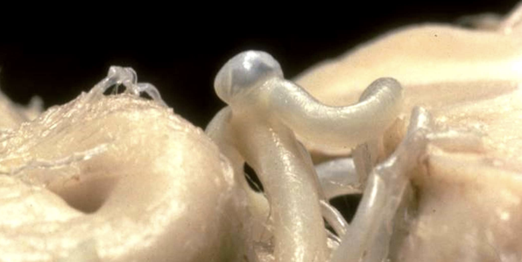 <p>Berry Aneurysm</p>