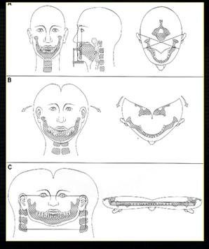 <p>this creates a complicated radiograph with several types of<strong> shadows superimposed on top of each other</strong> - image shows why the <strong>cervical spine appears on both sides</strong> of the image - anatomical structures are severely distorted </p>