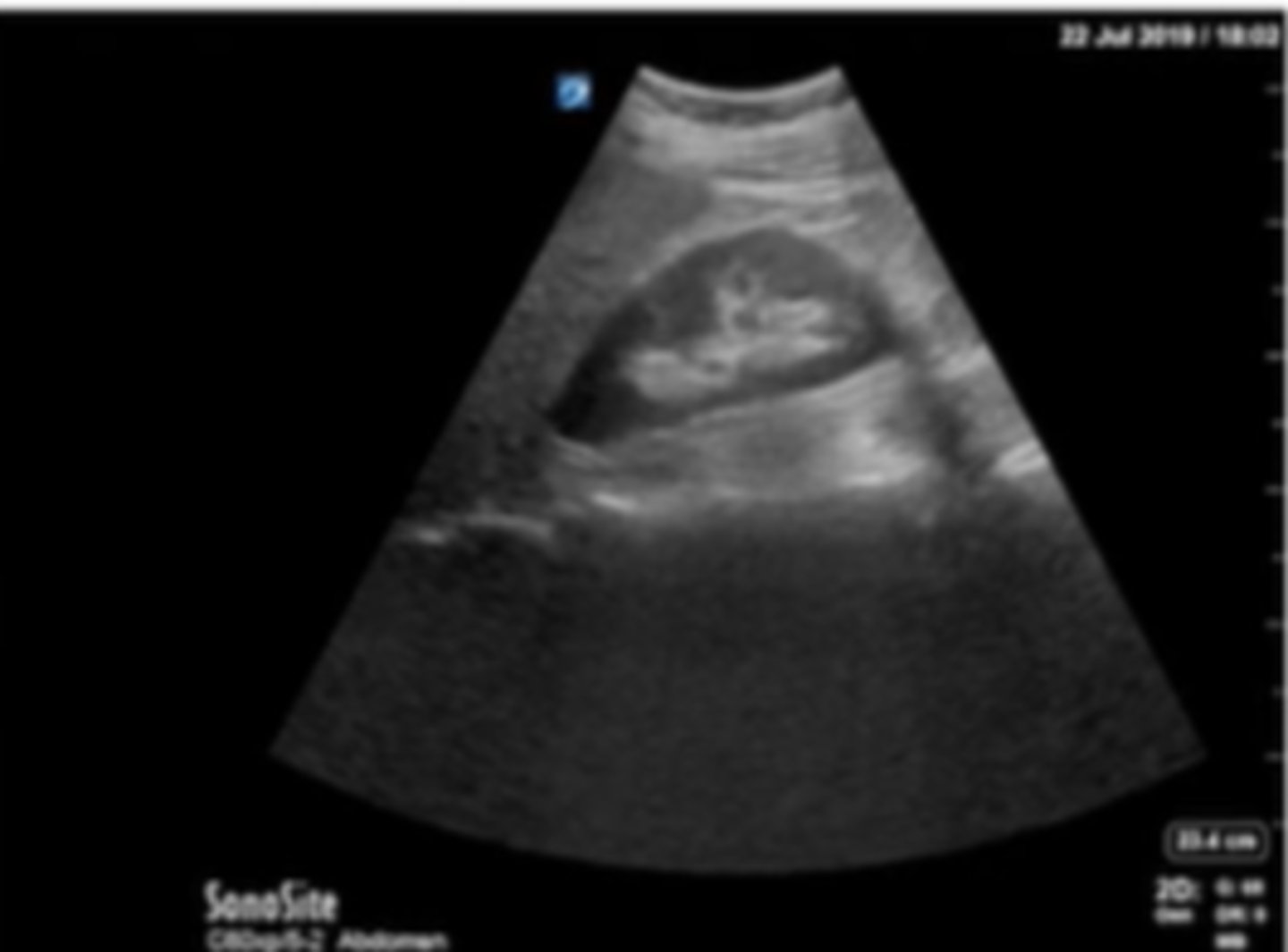 <p>how would you optimize this image on the kidney?</p>