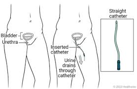 <p>What are the key care measures for a straight catheter?</p>