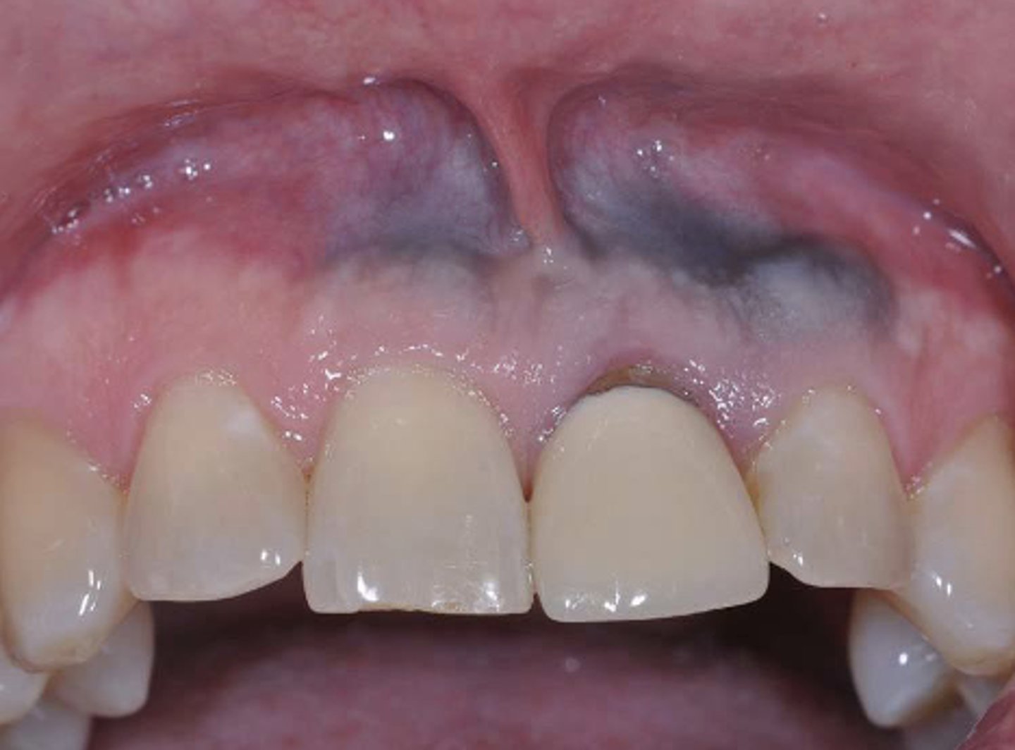 <p>What type of pigmented lesion?</p>