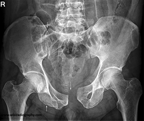 <p>High anteroposterior force, such as hitting a motorcycle tank or falling forward off a horse.</p>