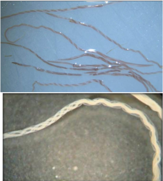 <p>What GIN is shown in this image </p><p>why </p><p>found where </p><p>symptoms of infection </p><p>ppp? </p>