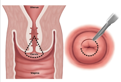 <ul><li><p>may remove cervical cancer or pre-cancerous tissue</p></li><li><p>May be used to analyze cells of suspicious lesions</p></li></ul><p></p>